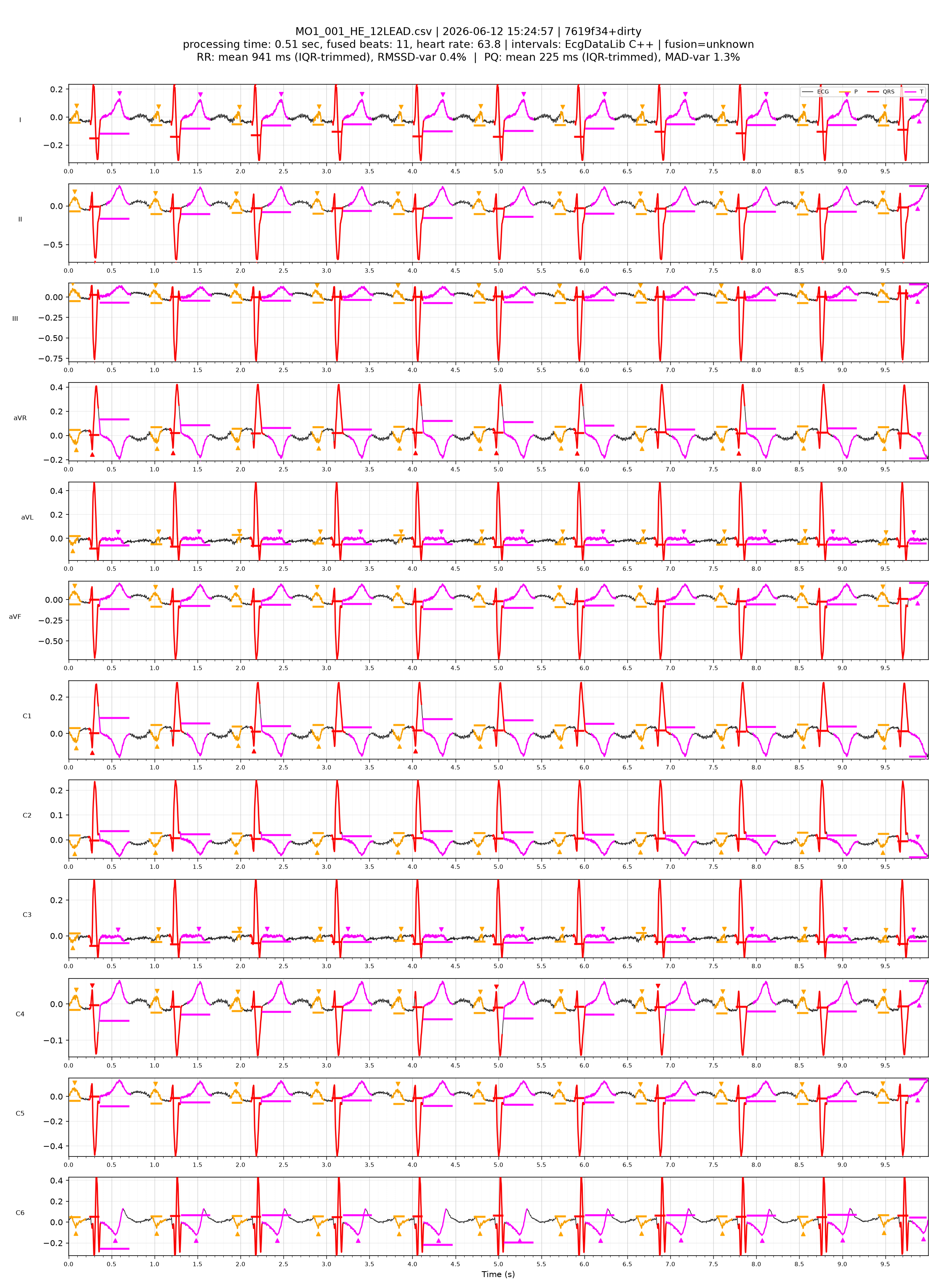 Normal sinus rhythm — annotated 12-lead ECG